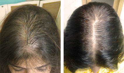 de la Alopecia con Plasma Rico Plaquetas Clínica Belmedic